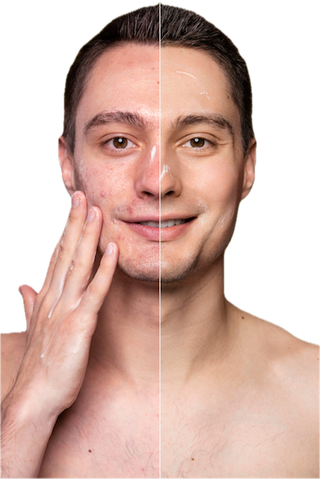 CREMĂ FĂCUTĂ MANUAL PENTRU TEN ACNETIC ȘI CU PROBLEME, 40 ml